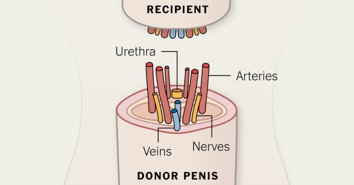 Penis Transplantation (Source: NY Times)